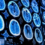 Close-up of CT scan of the brain. 